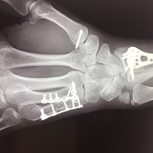 Fracturas de la extremidad superior