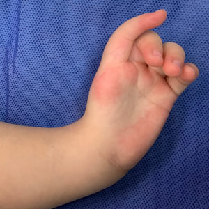 Cirugía de Mano Congénita