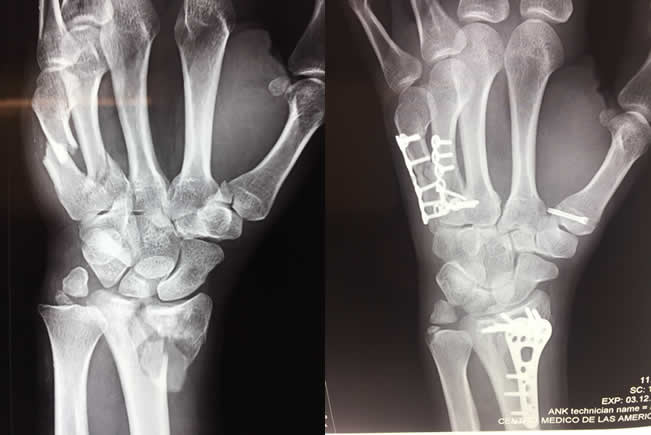 Fracturas de la extremidad superior