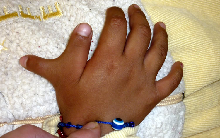 Cirugía de Mano Congénita